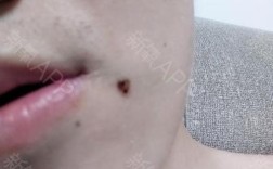 萍乡点痣哪里比较好呀？萍乡点痣哪种好激光多少钱