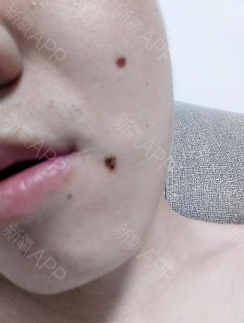 萍乡点痣哪里比较好呀?萍乡点痣哪种好激光多少钱-图1 萍乡点痣哪里比较好呀?萍乡点痣哪种好激光多少钱-图1