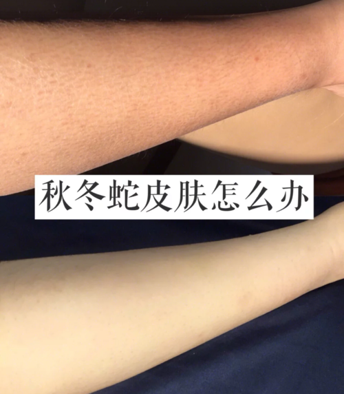 皮肤干燥脱皮怎么办?日本长野县最冷天气多少度-图2 皮肤干燥脱皮怎么办?日本长野县最冷天气多少度-图2